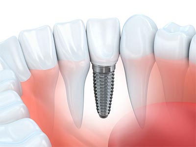 Próteses e implantes Próteses dentárias
