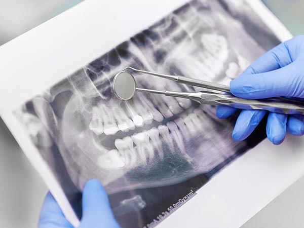 Tratamentos de canal Endodontista