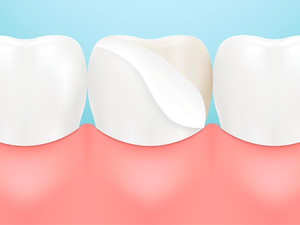 Aplicação de lente de contato dental Lente de contato para os dentes