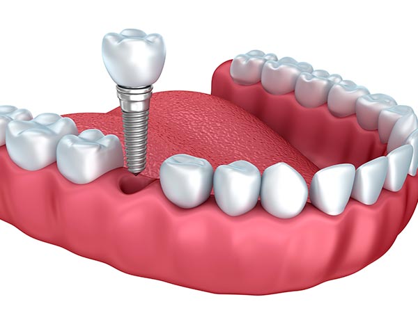 Próteses dentárias Implantes e próteses para os dentes