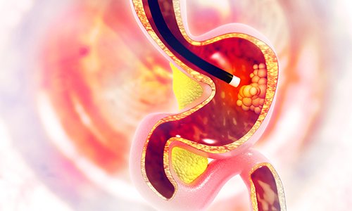 endoscopia endoscopia