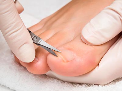 O corte incorreto das unhas pode causar problemas Corte correto das unhas