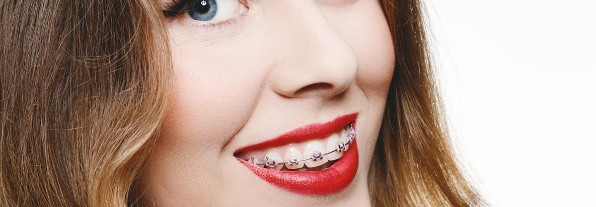 Aparelhos ortodônticos Aparelhos para os dentes