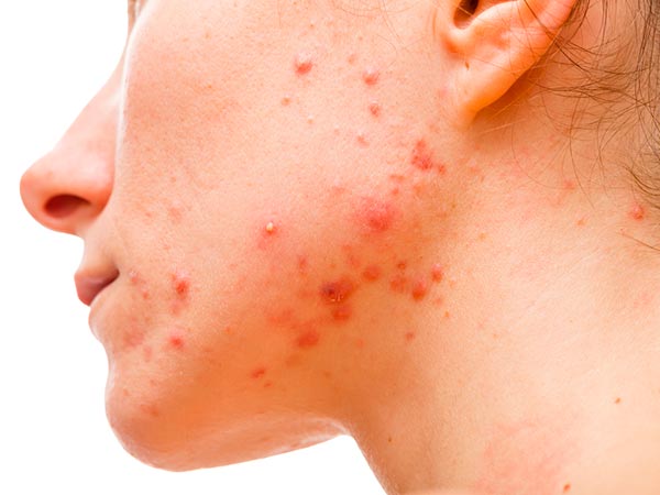 Tratamento para acne Tratamento para espinhas e cravos