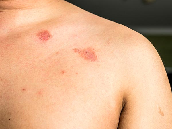 Tratamento de micoses, verrugas e pintas Tratamento de micoses e doenças que acometem a pele