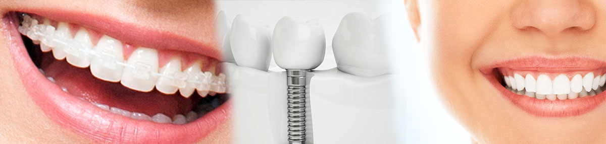 Estética, clareamento e implantes Tratamentos odontológicos