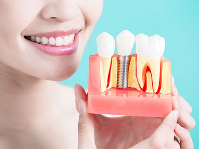 Implantes Implantes