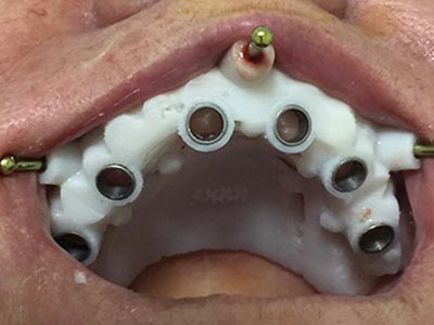 Implante sem cortes Cirurgia guiada
