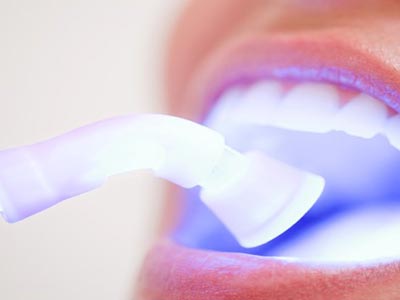Restauração e clareamento a laser Restauração e clareamento dos dentes