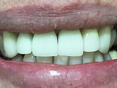 Aplicação de lentes de contato dental Lentes de contato dental