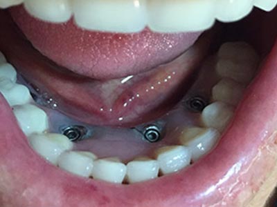 Prótese dental Prótese dental