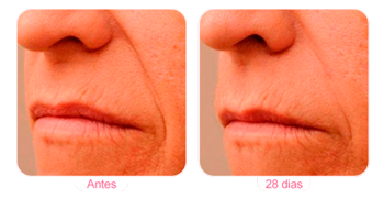 Antiaging Hyanify - Antes e Depois Antiaging Hyanify