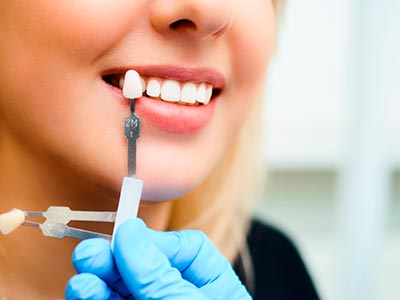 Implantes para os dentes Implantes odontológicos