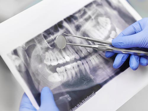 Tratamento de canal Endodontia