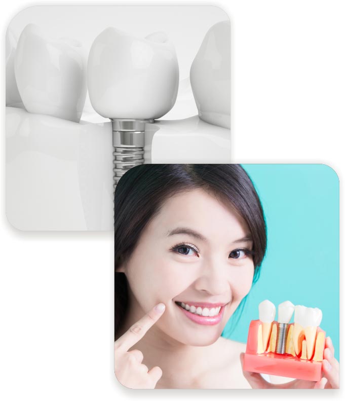 Implantes odontológicos Implantes odontológicos