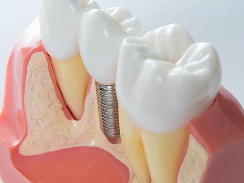 Implantes dentários Implantes dentários