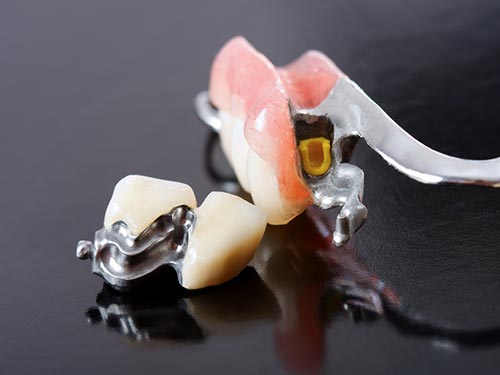 Próteses para os dentes Próteses dentárias