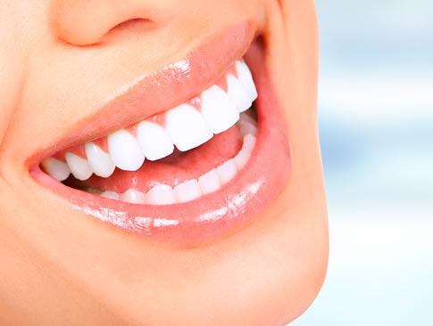 Clareamento a laser Clareamento dental