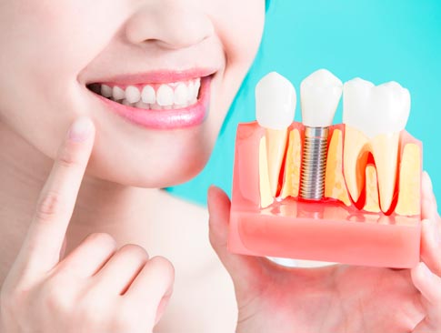 Implantes odontológicos Implantes