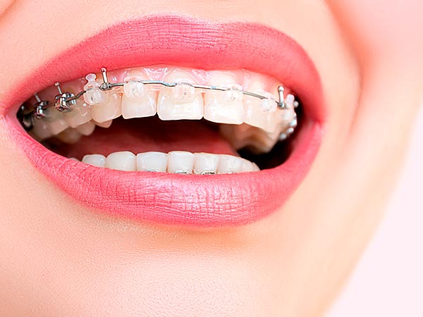 Aparelhos metálicos Aparelho para os dentes