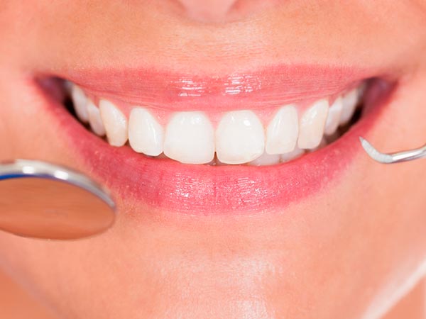 Lente de contato dental Lente de contato dental