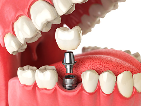 A colocação de implantes dentários é um procedimento muito usado para repor um ou mais dentes que foram perdidos Implante dentário