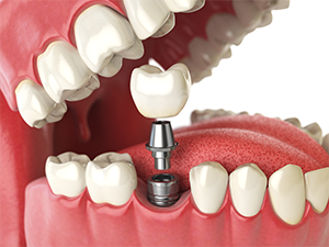 Restaurações e implantes Restaurações e implantes