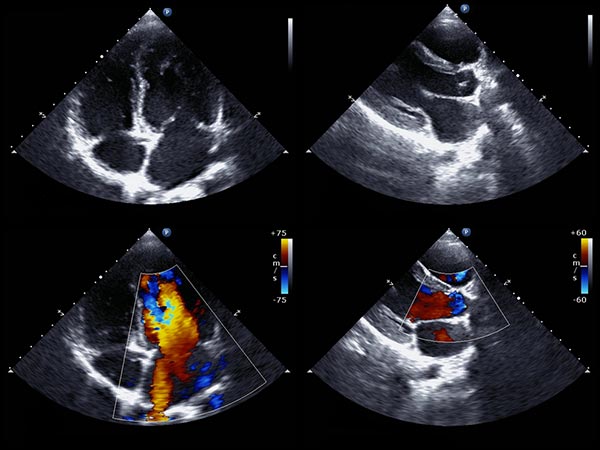 Ecocardiograma transtorácico Ecocardiograma transtorácico