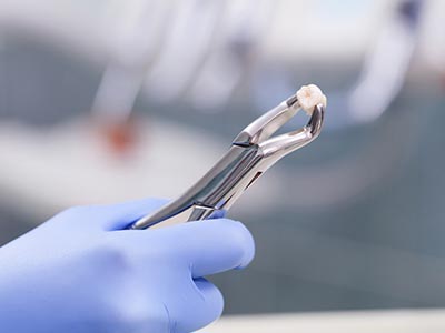 Cirurgias para tratar diversas doenças que afetam a boca Dente extraído