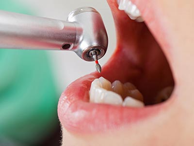 Procedimentos para recuperar dentes danificados Dente sendo obturado