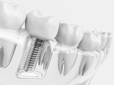 Reposição dos dentes com o uso de próteses, implantes e dentaduras Modeli de implante dentário