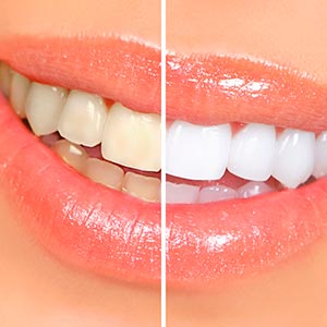 Dentística (clareamento e restauração) Dentística (clareamento e restauração)