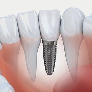 Implante dentário e próteses Implante dentário e próteses