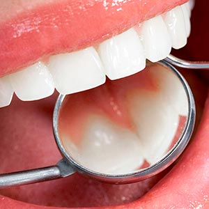 Periodontia (limpeza) Periodontia (limpeza)