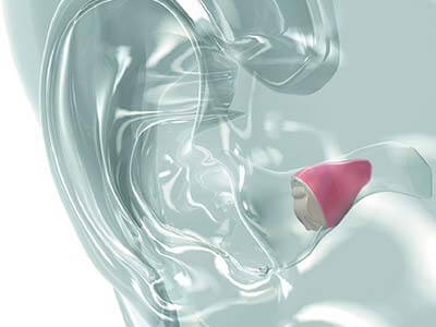 Aparelhos intracanal Aparelhos auditivo interno