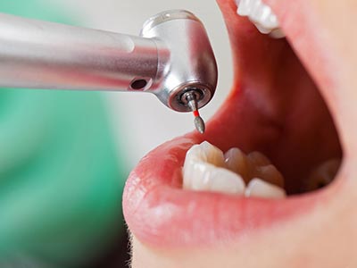 Tratamento de canal e endodontia geral Endodontia