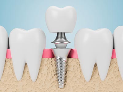 Implantes dentários Implantes dentários