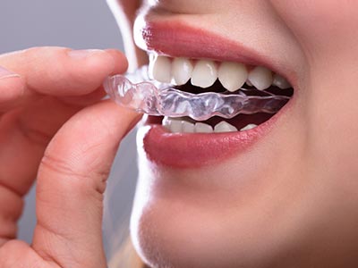 O tratamento com Invisalign é a alternativa estética para metais e bráquetes para crianças, adolescentes e adultos Alinhadores Invisíveis (Invisalign)