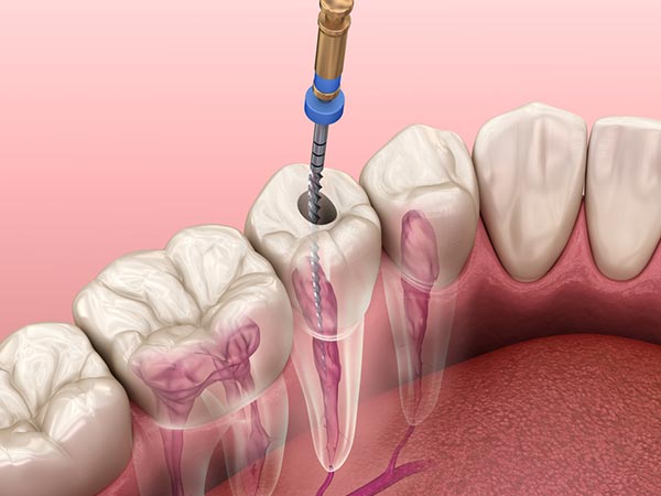 Tratamento de canal e outros procedimentos Endodontia