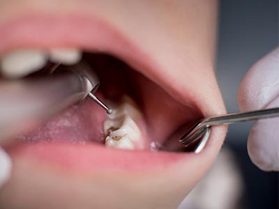 Restauração de dentes quebrados e careados Obturação