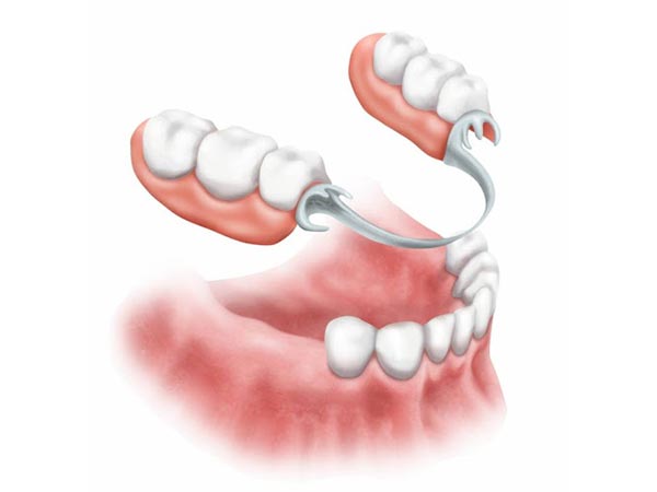 Próteses dentárias Próteses dentárias