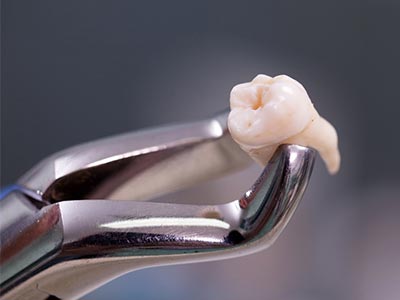 Extração de dentes inclusos Extração de dentes