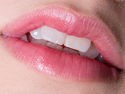 Camada fina feita especialmente para cobrir a frente de um dente com o intuito de corrigir imperfeições Lente de contato dental