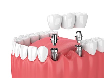 Substituição de dentes perdidos com o uso de próteses pontes fixas e provisórias Próteses e implantes odontológicos