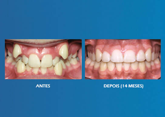 Aparelho Dentário com Brackets Autoligados aparelho-dentario-brackets-autoligados