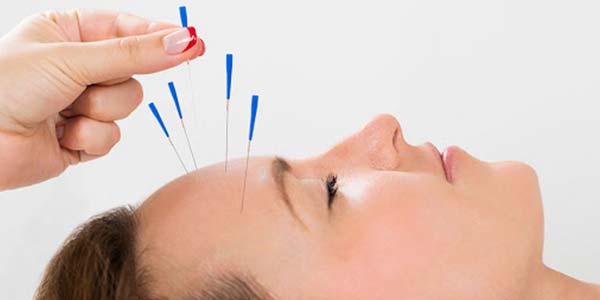 Acupuntura Acupuntura