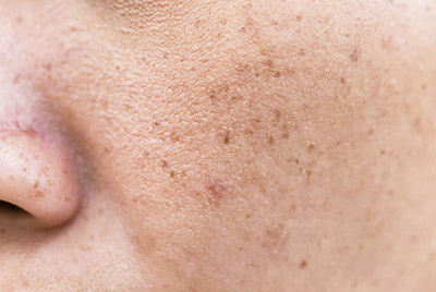 melasma melasma