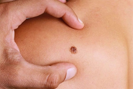 dermatoscopia dermatoscopia