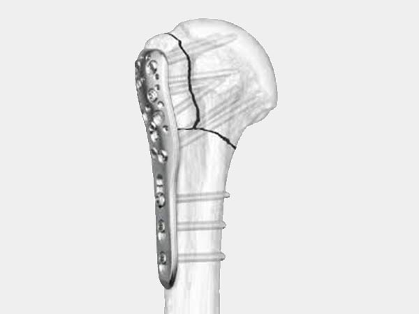 Osteossíntese de fraturas Osteossíntese de fraturas