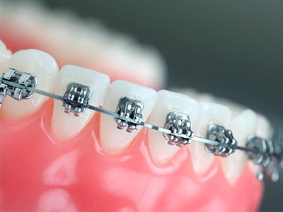Ortodontia aparelho para os dentes